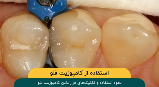 قرار-دادن-کامپوزیت-فلو